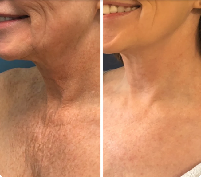 Lunaraa®  Neck Mask